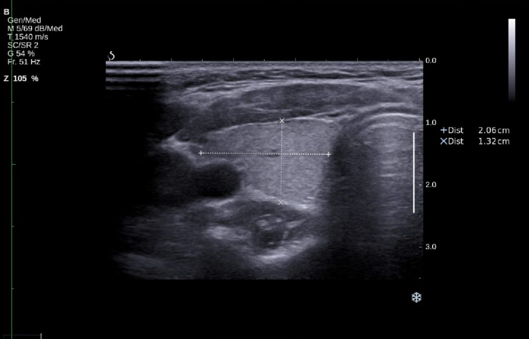 USG Tarczycy Wrocław Badanie i Konsultacja Port Zdrowia