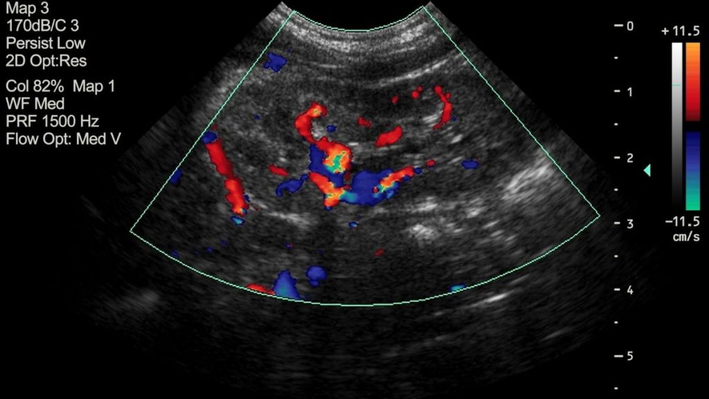 Badanie USG doppler tętnic nerkowych przeprowadzone przy pomocy fal ultradźwiękowych